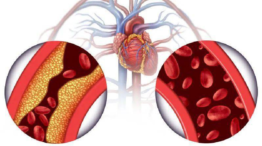 ภาพเปรียบเทียบหลอดเลือดหัวใจปกติและที่ตีบ