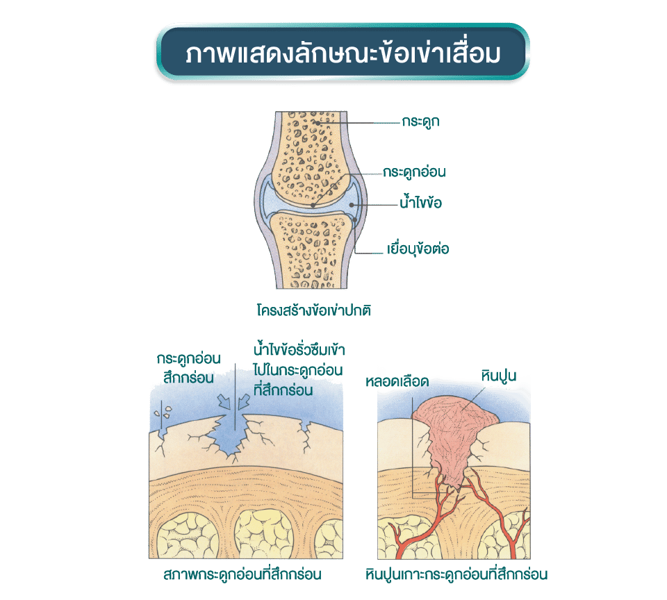 ภาพแสดงลักษณะข้อเข่าเสื่อม