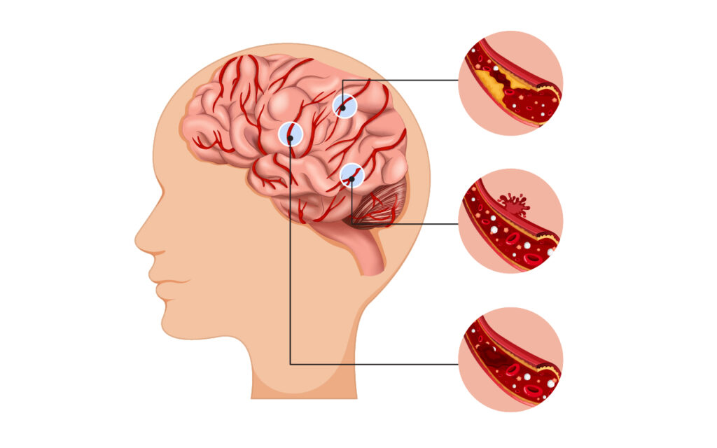 ดูแลหลอดเลือด ลดความเสี่ยงสโตรก ด้วยนวัตกรรมสมุนไพรจีน