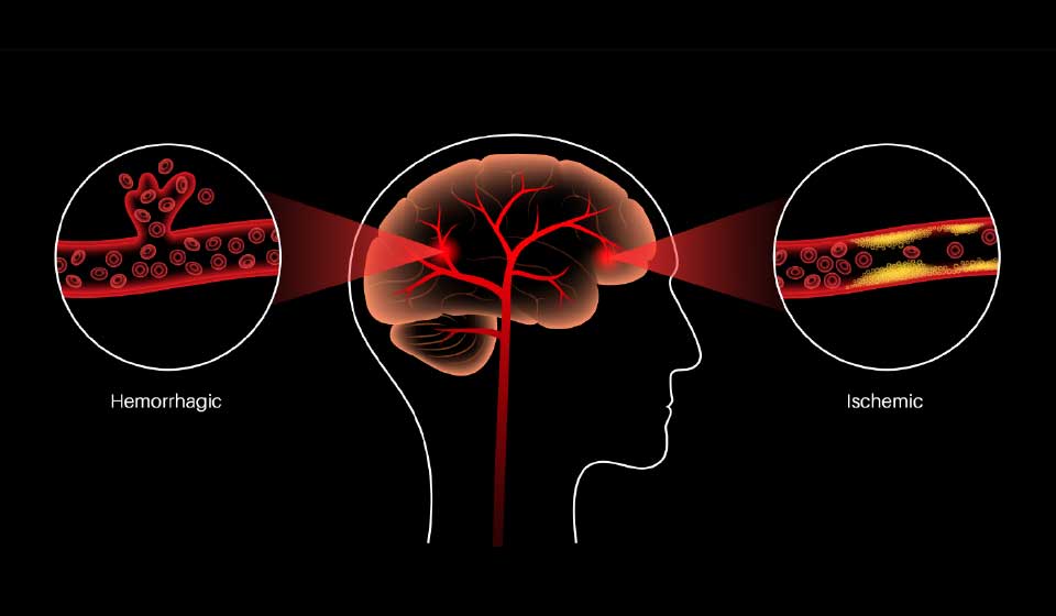 อาการโรคหลอดเลือดสมองตีบ ตัน แตก ป้องกันรักษาได้ด้วยนวัตกรรมสมุนไพรจีน