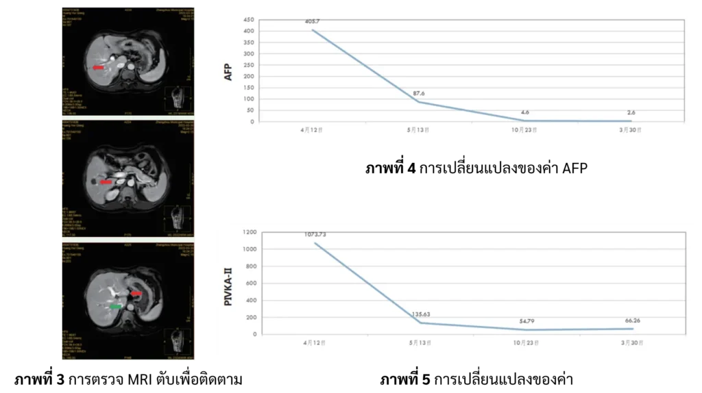 ผลตรวจ MRI ติดตามผลมะเร็งตับ และกราฟค่า AFP