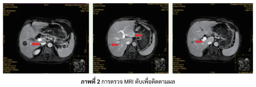 ผลตรวจ MRI ติดตามผลมะเร็งตับ
