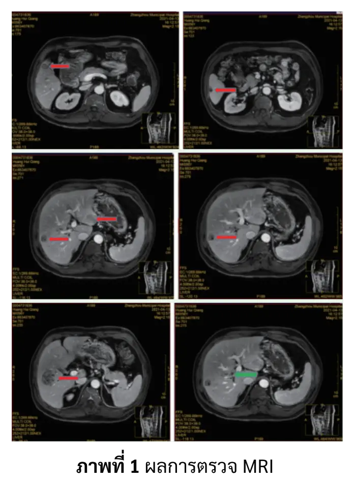 ผลตรวจ MRI ติดตามผลมะเร็งตับ