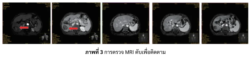 การตรวจ MRI ผู้ป่วยมะเร็งตับ