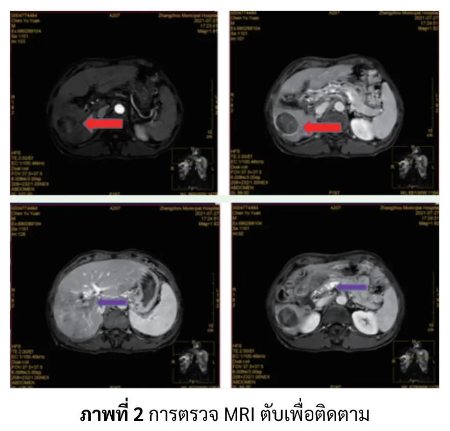 การตรวจ MRI ผู้ป่วยมะเร็งตับ