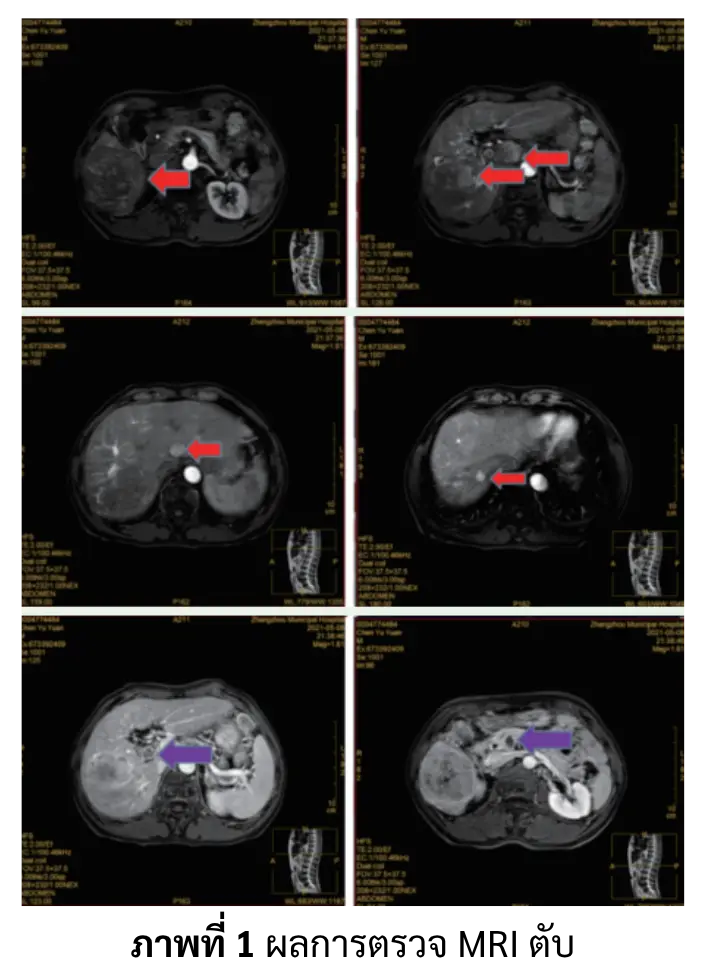 การตรวจ MRI ผู้ป่วยมะเร็งตับ