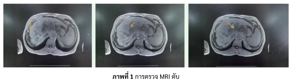 ผลตรวจ MRI ผู้ป่วยมะเร็งตับ