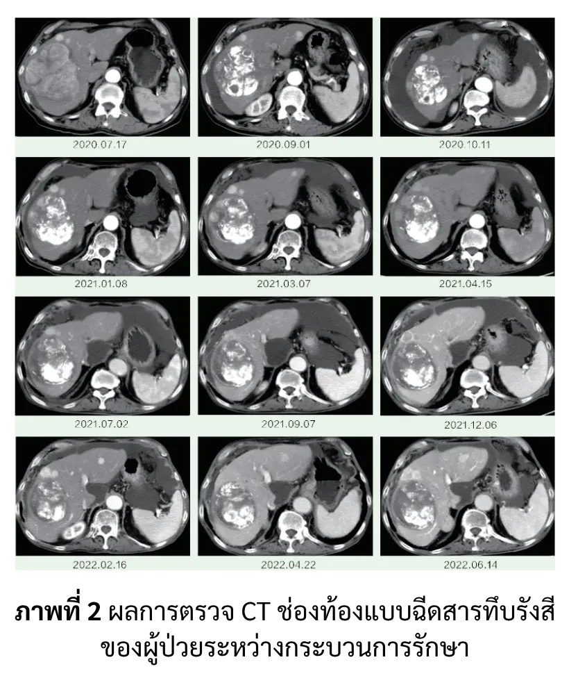 ผลตรวจ CT ช่องท้องแบบฉีดสารทึบรังสี ผู้ป่วยมะเร็งตับ