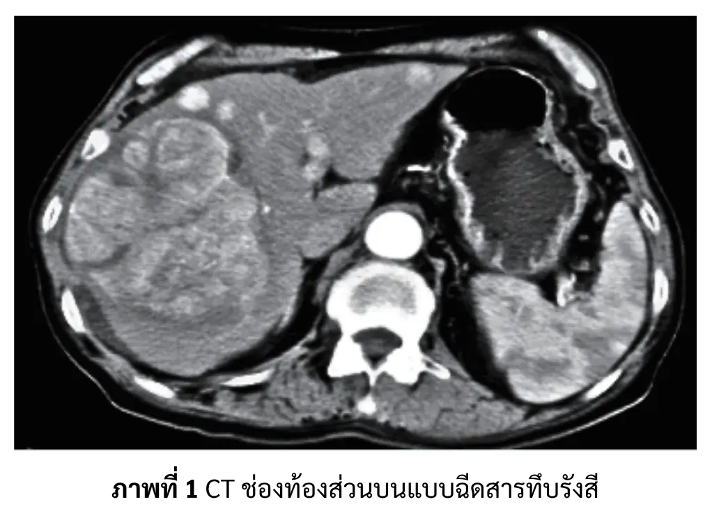 ผลตรวจ CT ช่องท้องแบบฉีดสารทึบรังสี มะเร็งตับ