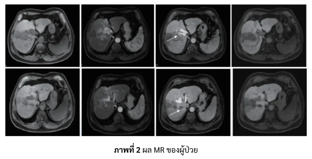 ผล MRI ของผู้ป่วยมะเร็งตับ