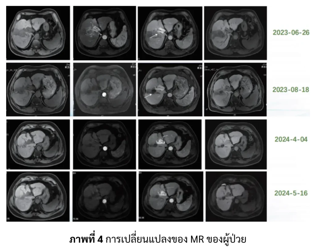 ผล MRI ของผู้ป่วยมะเร็งตับ เทียบหลายช่วงเวลา