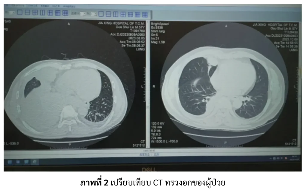 ภาพเปรียบเทียบ CT ทรวงอกของผู้ป่วย