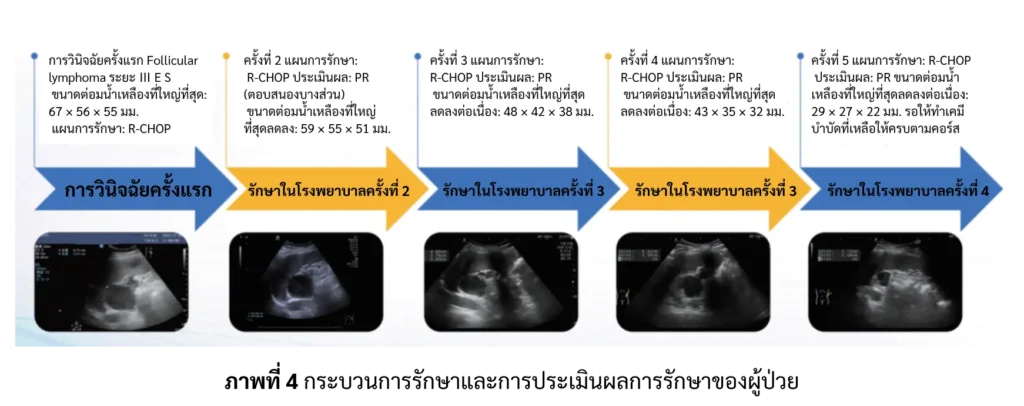 กระบวนการรักษา ผู้ป่วยมะเร็งต่อมน้ำเหลือง