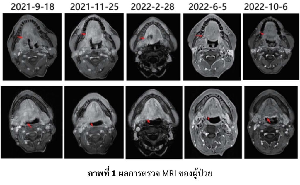 ผลการตรวจ MRI ผู้ป่วยมะเร็งจมูก