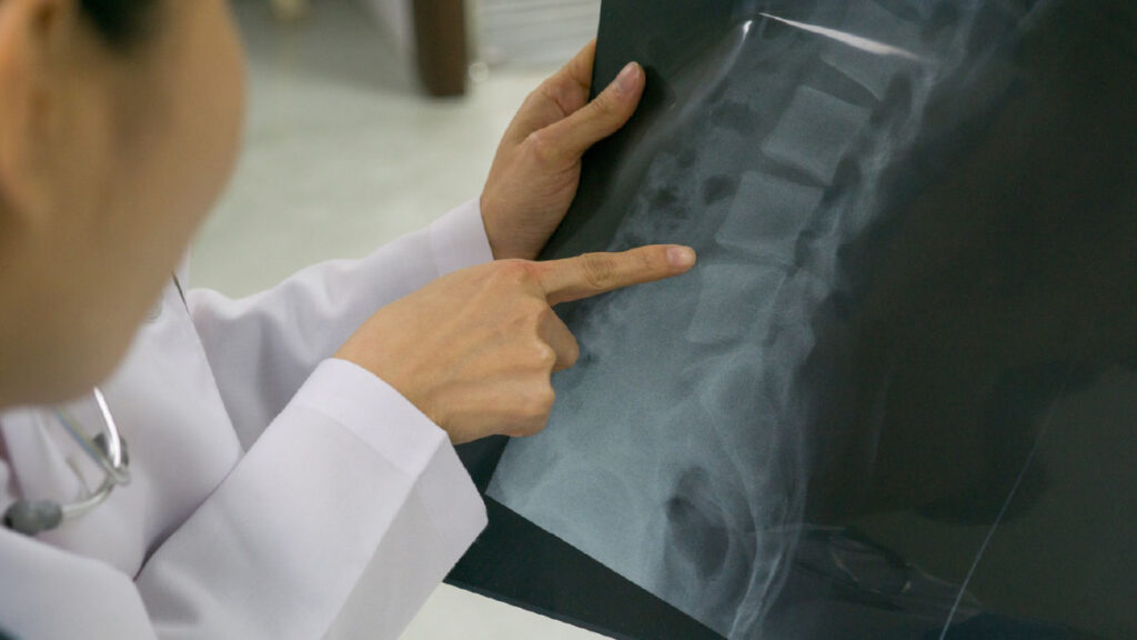 กระดูกทับเส้นตรวจอย่างไร? ต้องเอกซเรย์หรือ MRI