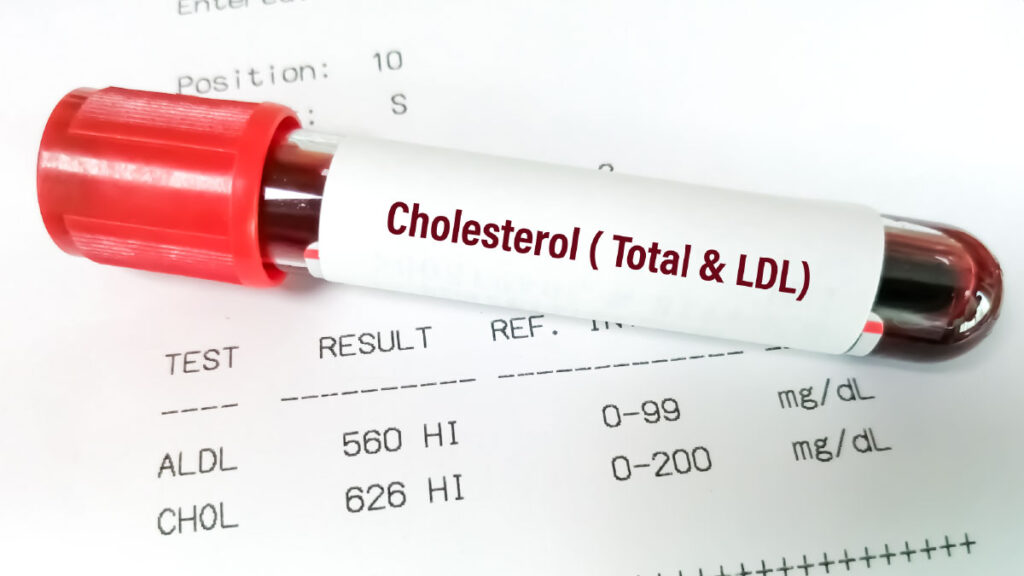 ค่าไขมันในเลือดเท่าไรจึงถือว่าปกติ? วิธีอ่านผลตรวจ LDL, HDL และ Triglyceride