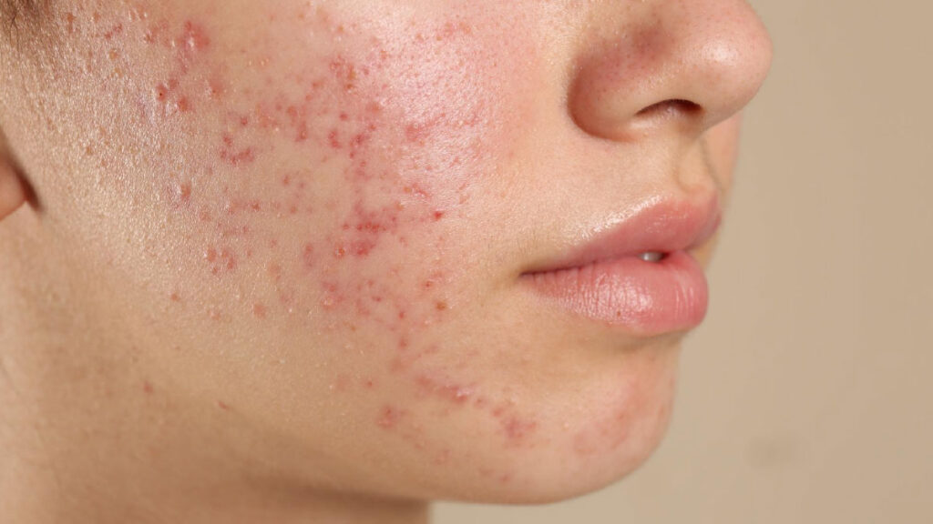 PCOS ทำให้สิวขึ้นและขนดกจริงหรือไม่? เข้าใจสาเหตุและวิธีดูแล