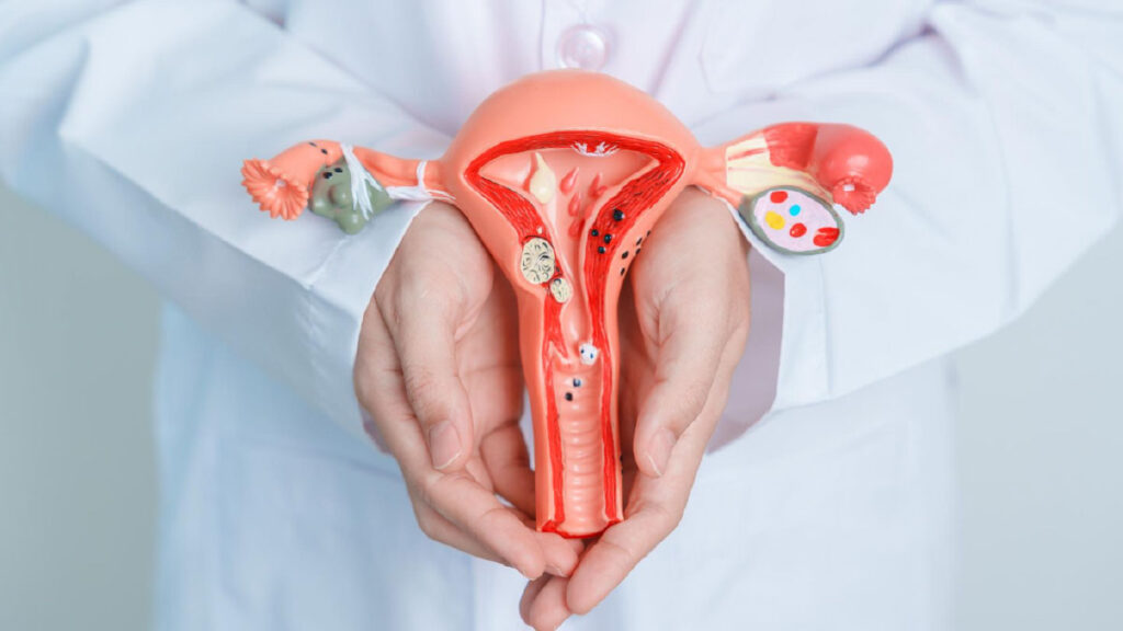 รักษา PCOS อย่างไร? แนวทางควบคุมอาการและลดความเสี่ยงในระยะยาว