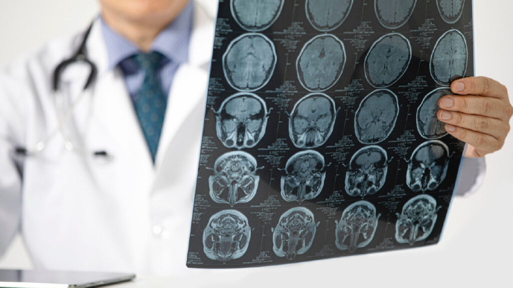 โรคหลอดเลือดสมองตรวจอย่างไร? CT Scan กับ MRI ต่างกันไหม