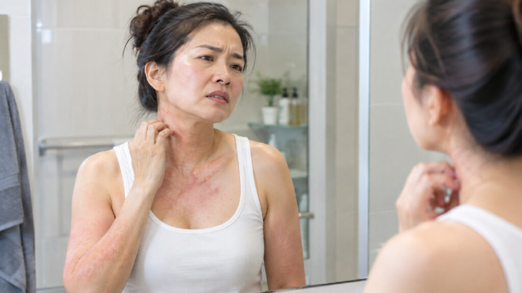 ผื่นคันเรื้อรัง คันไม่หาย ทำไม Eczema ถึงกลับมาเป็นซ้ำ?