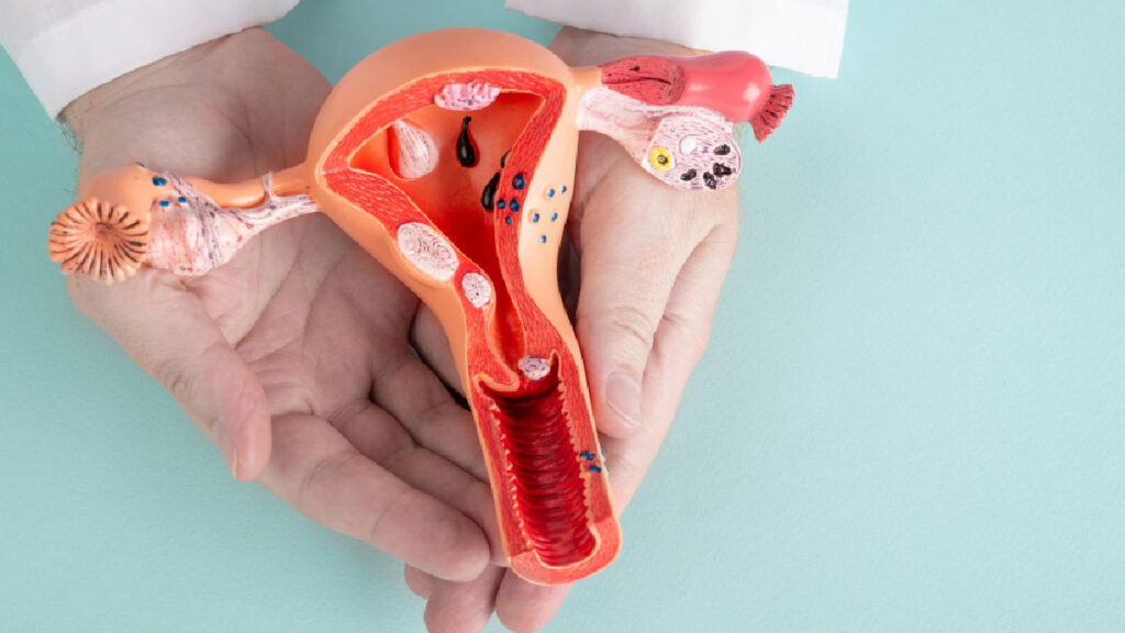 Chocolate Cyst เกิดจากอะไร? สาเหตุและปัจจัยที่เกี่ยวข้อง