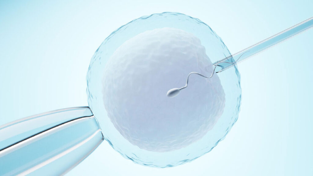 Chocolate Cyst ทำ IVF/ICSI ได้ไหม? ต้องผ่าตัดก่อนหรือไม่