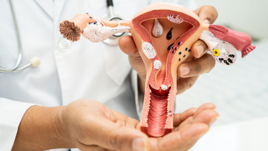 Chocolate Cyst รักษาอย่างไร? ยา ผ่าตัด หรือติดตามอาการ